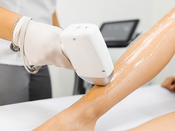 Dauerhafte Haarentfernung mit dem Diodenlaser